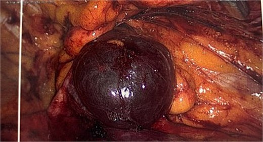 Intraoperative image of the hydrocele (instrument overlying the inferior epigastric vessels.