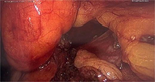 Intraoperative picture following excision of the hydrocele demonstrating the resulting defect.