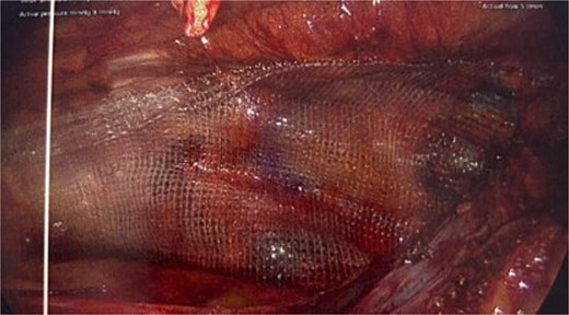 Intraoperative picture showing the progrip mesh in situ now covering the defect.