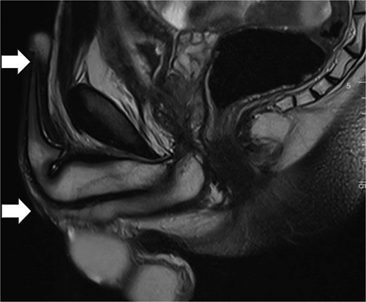 Sagittal MRI of the pelvis demonstrating a pan-urethral stricture. The urethra shows a long segment narrowing extending between the two arrows.