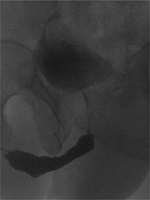 Post buccal graft mucosal urethroplasty urethrogram, showing wide urethra at the site of repair without recurrence.
