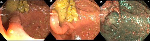 Colonoscopic image of the cecum showing characteristic features consistent with an inverted appendix.