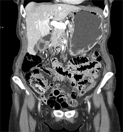 Coronal contrast-enhanced CT scan demonstrating an elongated structure projecting into the cecal lumen from the appendiceal orifice, consistent with an inverted appendix.