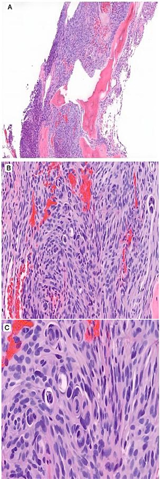 Histopathology (H&E). (A) Low-power view (×4) showing a spindle cell neoplasm infiltrating lamellar bony trabeculae. (B) Intermediate-power view (×10) demonstrating meningothelial proliferation arranged in lobules with early whorl formation. (C) High-power view (×20) showing well-formed whorls and characteristic intranuclear pseudoinclusions, supporting a meningothelial neoplasm.