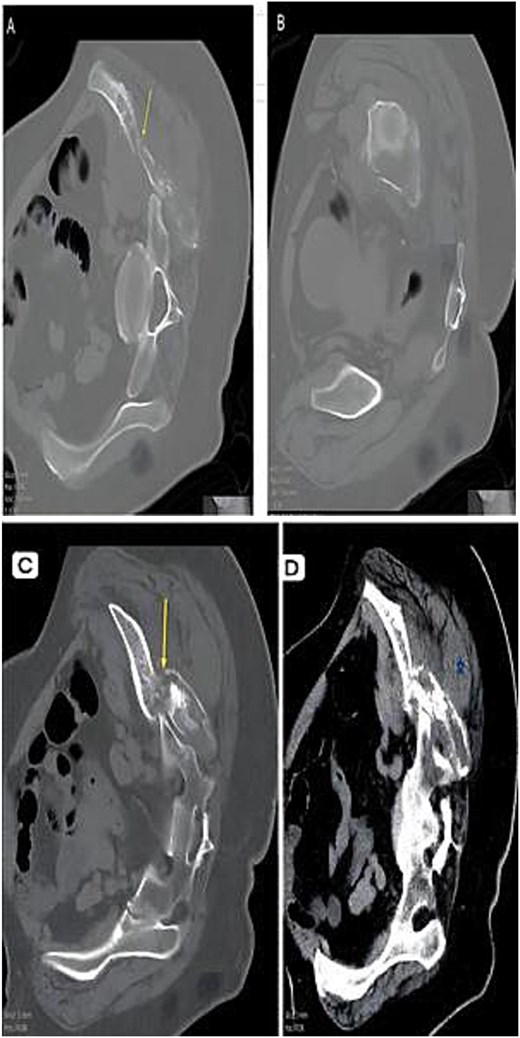 CT composite. (A) Axial CT—Lytic destructive lesion with cortical breach. (B) Follow-up CT—Progressive osseous destruction & soft-tissue expansion. (C) Bone window—Cortical destruction (arrow). (D) Contrast CT—Enhancing soft-tissue mass replacing marrow (asterisk).