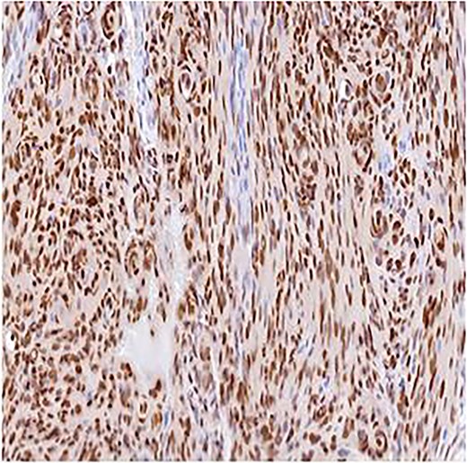 Immunohistochemistry for PR, ×10. Strong nuclear staining within meningothelial tumor cells confirming meningioma differentiation.