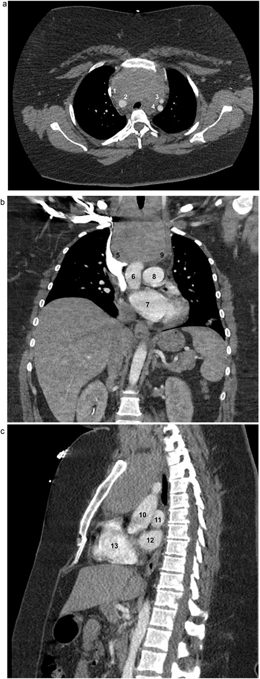 Axial (a), coronal (b), and sagittal (c) contrast-enhanced CT images of the chest demonstrating marked thyromegaly with retrosternal and intrathoracic extension (craniocaudal dimension up to 14 cm), resulting in tracheal narrowing at the thoracic inlet. In the axial view, the (1) superior vena cava (SVC), (2) brachiocephalic artery, (3) left common carotid artery, and (4) left subclavian artery are identified. In the coronal view, the (5) SVC, (6) ascending aorta, (7) left atrium (LA), (8) main pulmonary artery, and (9) brachiocephalic vein are identified. In the sagittal view, the (10) aorta, (11) left pulmonary artery, (12) LA, and (13) right ventricle are identified.