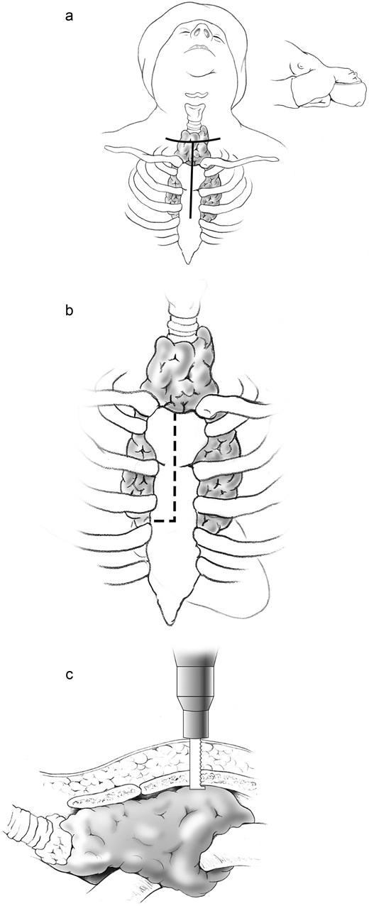 (a) A standard low cervical collar incision is created one fingerbreadth above the sternal notch, following a natural skin crease, with inferior extension from its midpoint to the angle of Louis. (b) A partial upper sternotomy is performed to the level of the third intercostal space, with transverse extension into the right third intercostal space. (c) The upper sternotomy is carried out using a standard sternal saw, and the transverse extension into the right third intercostal space is completed with an oscillating saw.