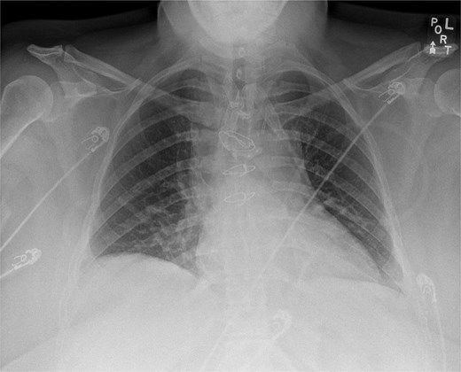 Postoperative chest X-ray demonstrating sternal wire and sternal plate closure.