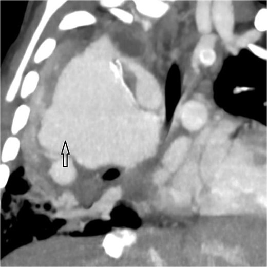 Coronal oblique maximum-intensity-projection reconstruction of thoracic CT angiography showing a large thrombosed pseudoaneurysm of the right subclavian artery at the anastomosis with the modified Blalock–Taussig–Thomas shunt, causing significant mediastinal mass effect.