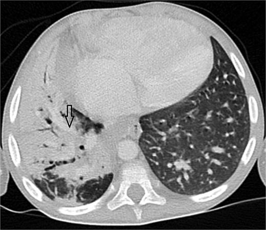 Axial CT angiogram in lung window demonstrating right lower-lobe consolidation and volume loss with mediastinal shift, consistent with pneumonia and compression by the pseudoaneurysm.