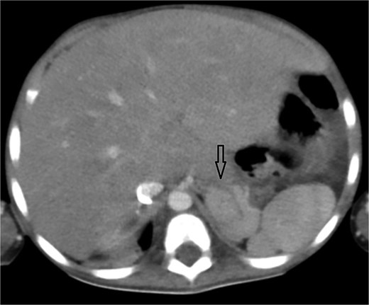 Axial abdominal CT showing central liver and polysplenism, compatible with left isomerism.