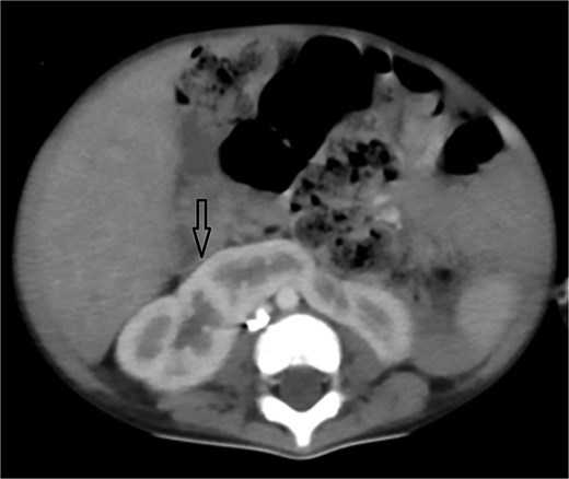 Axial abdominal CT demonstrating a horseshoe kidney.