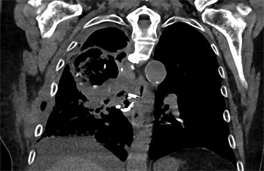 Coronal CT showing large cavitary lesion in the right upper lobe measuring 10.0 × 6.0 cm, loculated right pleural effusion, complex chest wall fluid collection.