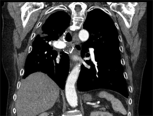CT chest at 6 months with contrast with trace loculated pleural effusion and improved consolidation.