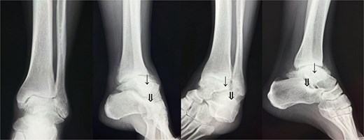 Preoperative radiological imaging: X-ray finding. The patient presented with end-stage osteoarthritis of the tibiotalar joint, characterized by flattening of the joint surface and subluxation of the talus (↓). Although mild arthritic changes were observed in the subtalar joint (⇓), its articular surface remained preserved.