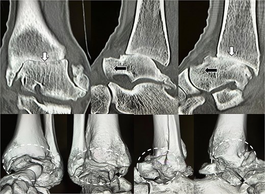 Preoperative radiological imaging: CT finding. The articular surface is completely collapsed and obliterated (1: white arrowhead). The talus is positioned in a subluxated state, and multiple osteophytes are observed on the medial, lateral, and posterior aspects (2–4: black arrowhead / circle with dotted outline). Both radiographs and CT images demonstrated end-stage osteoarthritis of the ankle, characterized by complete collapse of the articular surface and multiple osteophytes along the anterior, lateral, and posterior aspects of the joint (circle with dotted outline).