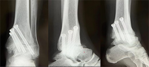 Immediate postoperative radiograph (X-ray). Ankle arthrodesis using three 6.5-mm cannulated cancellous screws (CCS).