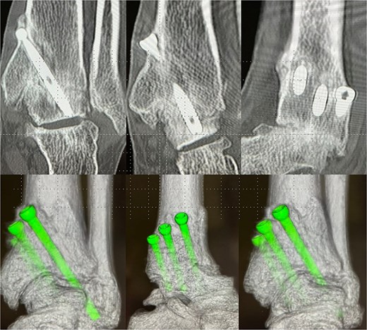 Postoperative-6 months radiological imaging: CT finding. The tibiotalar joint has achieved bony union, and the articular surfaces are anatomically reduced with a horizontal alignment.
