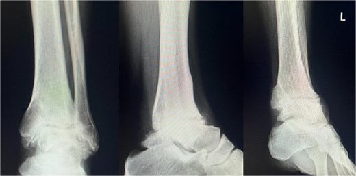 Plain radiograph after hardware removal. At 1.5 years after surgery, the patient underwent hardware removal. Although the osteoarthritic changes in the subtalar joint have slightly progressed, radiographic evaluation confirmed solid osseous union at the tibiotalar joint.