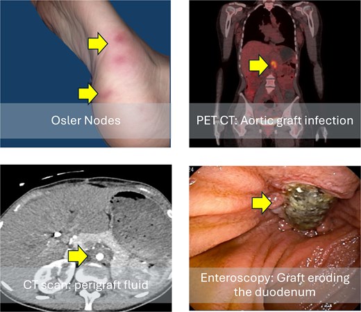 Clinical and radiological findings at patient admission. Osler nodes (red, tender, painful lesions on the plantar region of the right foot); computed tomography scan shows perigraft fluid; positron emission tomography (PET) scan with 18F-fluorodeoxyglucose increased metabolic activity in the graft region in axial; and image of an enteroscopy showing the graft eroding the third portion of the duodenum.