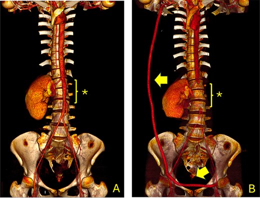 Computed tomography angiography (CTA) showing the aorta and iliac arteries. (A) Pre-operative CTA shows the area of the previous aortic graft (*); (B) Post-operative CT scan shows the axillofemoral bypass (arrow) and the aortic ligation (*).