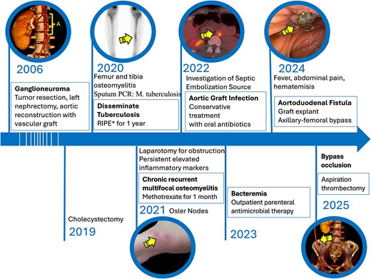 Timeline of patient’s symptoms, signs, diagnosis and interventions. (A) Computed tomography (CT) scan highlighting the region of the aortic graft. (B) Bone scan revealing an osteogenic lesion in the left tibia; *RIPE: Rifampicin, isoniazid, pyrazinamide and ethambutol. (C) Positron emission tomography CT scan with 18F-fluorodeoxyglucose indicating infection of the aortic graft. (E) Enteroscopy showing erosion of the duodenal wall. (E) Osler nodes in the patient’s foot. (F) CT scan depicting the axillobifemoral bypass.