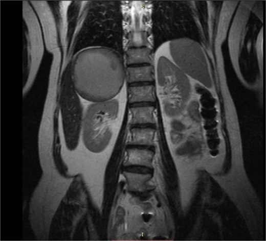 MRI caption showing a giant well-circumscribed right adrenal mass with solid components and thick fluid content. The remarkable dimension of the mass can be appreciated if compared to the right kidney.