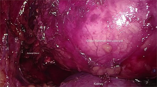 Intraoperative retroperitoneoscopic view showing the fully mobilized surgical specimen. The giant adrenal pseudocyst appears as a single, intact mass with the rest of the residual adrenal tissue attached medially. Due to its large size, the lesion cannot be entirely visualized within the operative field; its dimensions can be appreciated by comparison to the transverse diameter of the underlying right kidney.
