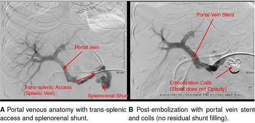 Interventional radiology image of coil and liquid embolization of a large splenorenal shunt with concurrent portal vein stent placement, performed for refractory hyperammonemia after liver transplantation.