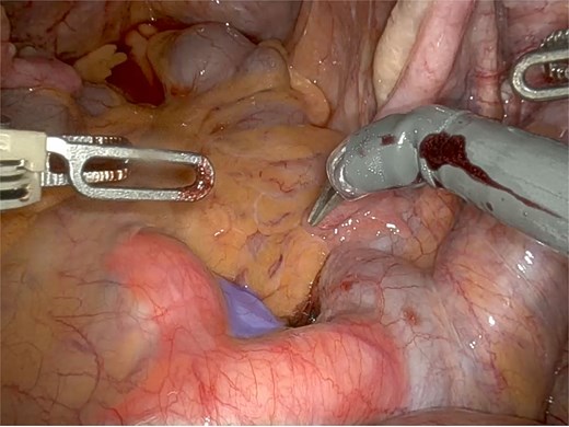 Anterior region to the promontory (in blue) showing varicosity of the sacral venous plexus, with tortuosity and ectasia of the middle sacral vein, positioned between the left and right common iliac arteries (in red).