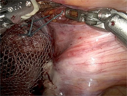 Adapted UPS technique with mesh fixation at the vaginal apex to the right iliopectineal ligament (*), using Ethibond® 2.