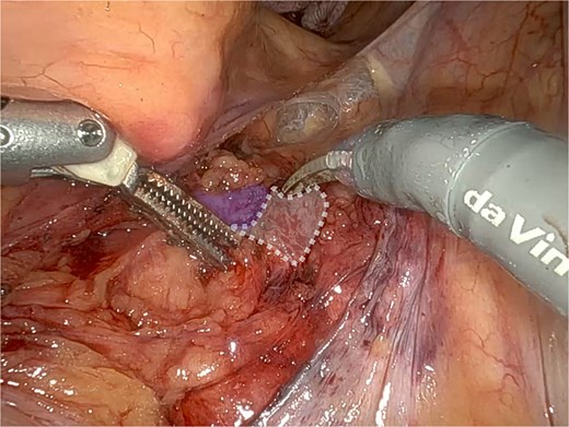 Promontory region showing evidence of surgical cement after spinal surgery (dashed line), located immediately adjacent to the middle sacral vessels (in blue).