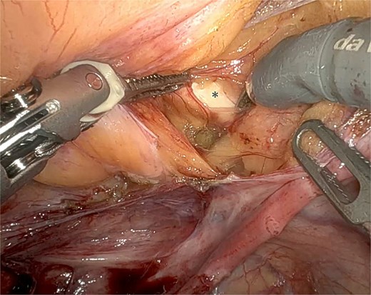 Dissection of the right iliopectineal ligament (*) following the UPS technique.