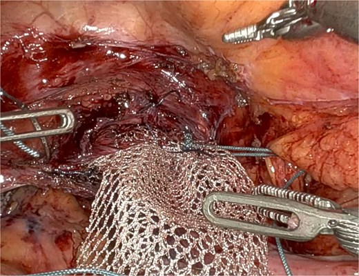 Mesh fixation at the vaginal apex to the right iliopectineal ligament, using Ethibond® 2, representing an adaptation of the original UPS technique.