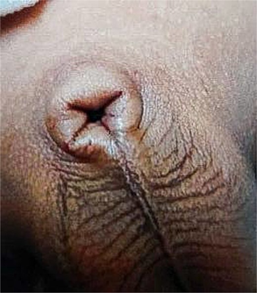 Appearance of penis following initial circumcision the glans was covered and unable to be visualized.