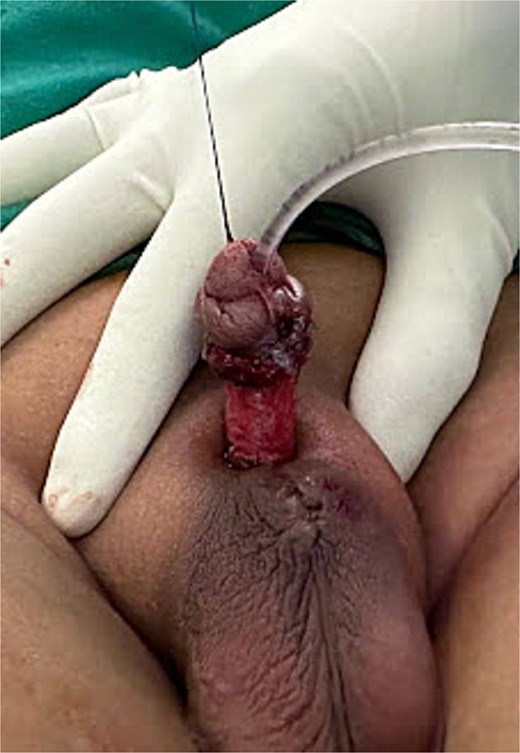 Penoscrotal anchoring with a stay suture at the dorsal side of the glans.