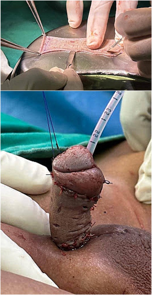 STSG harvested from the right anterolateral thigh was fenestrated and subsequently anchored to the glans penis.