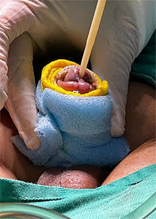 Modified circumferential box dressing applied to the grafted skin around the penis.