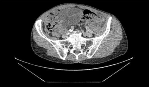 Transverse cross sectional view of mottled small bowel in the pelvis as a result of the closed loop obstruction.