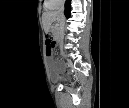 CT image showing a sagittal cross-sectional view of the affected SB loops.