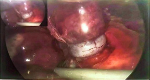 Operative image showing appendix wrapped around and constricting the terminal ileum (taken with permission).