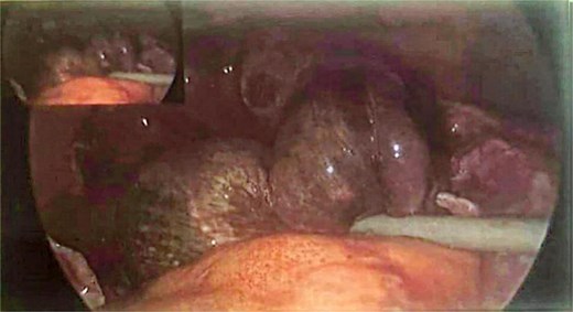 Operative image showing a panoramic view of the closed loop obstruction causing small bowel ischemia (taken with permission)
