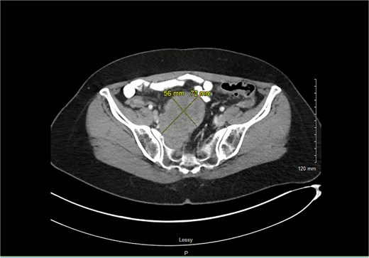 Axial imaging shows the schwannoma with greatest measurements of 7.2 × 5.6 cm.