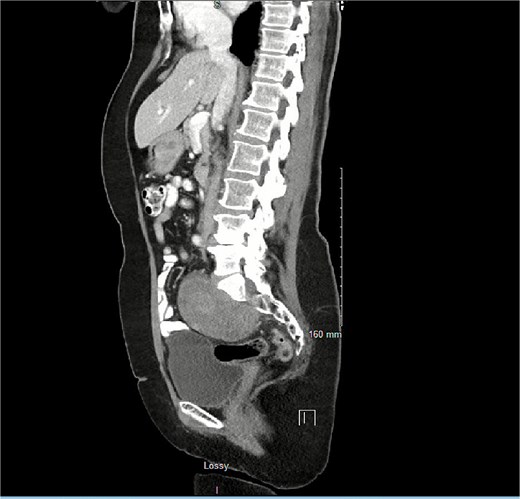 Proximity of schwannoma to rectosigmoid junction on saggital view on repeat scan months later.