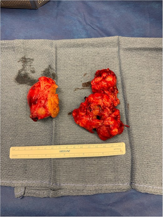 Specimen removed piece-meal.