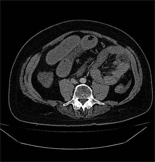 Contrast-enhanced axial CT abdomen: cluster of jejunal loops in the left upper quadrant forming a sac beneath the SMV, with proximal small-bowel dilatation consistent with closed-loop obstruction.