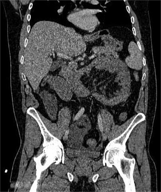 Coronal CT image showing clustered jejunal loops in the left abdomen with mass effect and convergence of mesenteric vessels toward the hernia orifice.