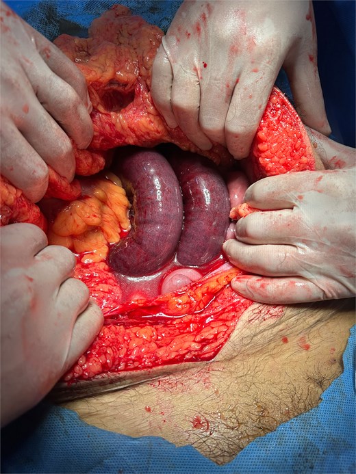 Intraoperative photograph demonstrating strangulated jejunal loops within the LPDH sac (note congestion and ischemic appearance).
