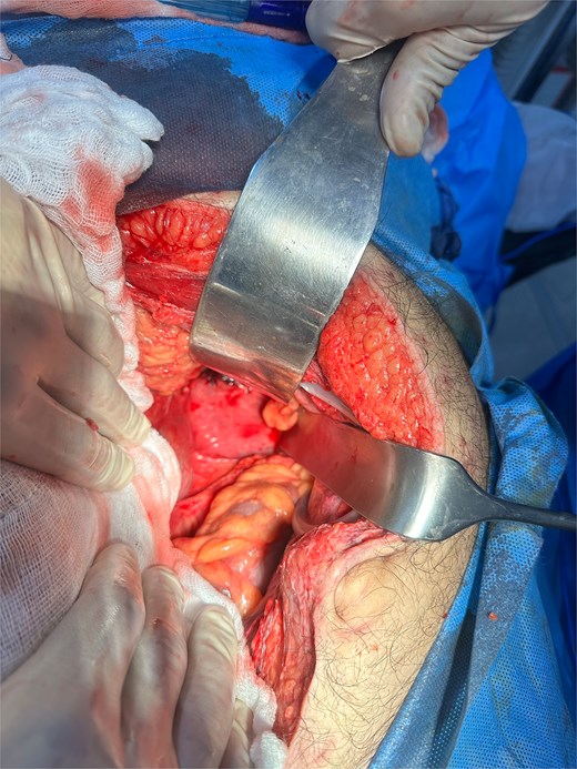 Shows left paraduodenal space after jejunal resection and excision of hernia sac.